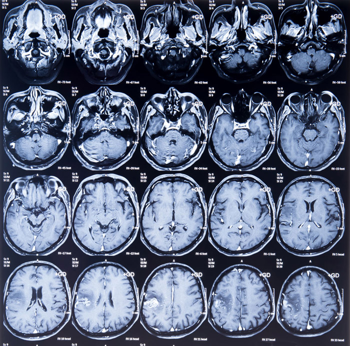 Multiple-Sclerosis-Clinical-Trials